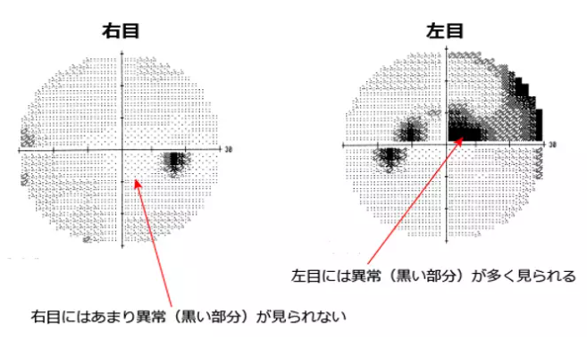眼底検査