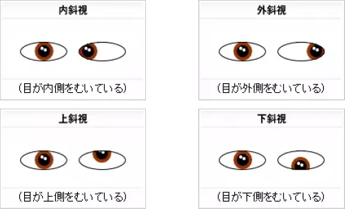 斜視