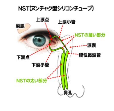 NSチューブ