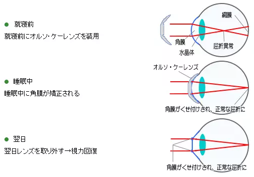角膜形状矯正の仕組み