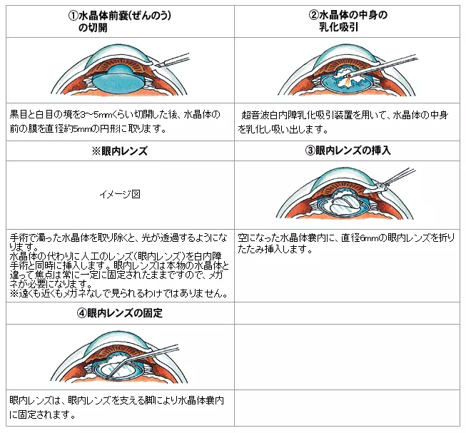 白内障手術の流れ