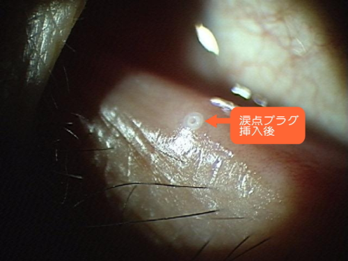 涙点プラグ挿入後